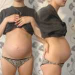 Острый живот на 24-й неделе беременности