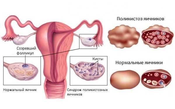Схема поликистоза яичников