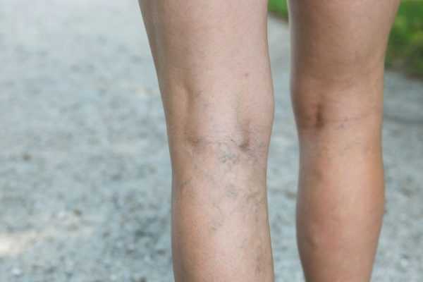 Женские ноги с тромбозом