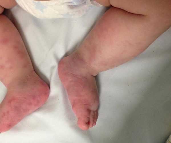 Ножки малыша с покраснениями и гематомами