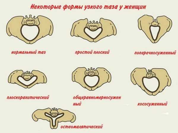 Формы анатомически узкого таза у женщин