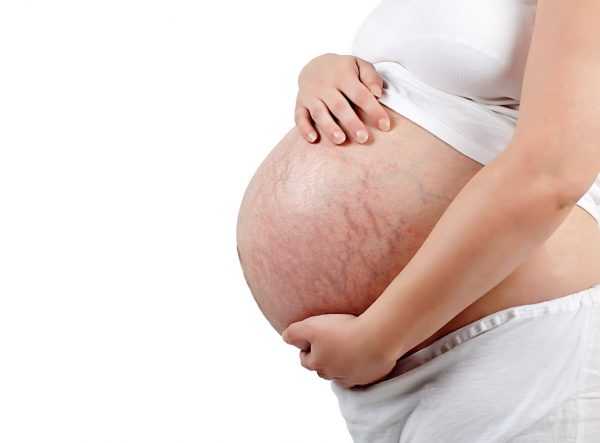 Растяжки на животе у беременной