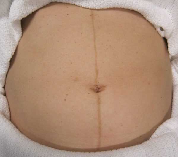 Пигментная полоса на животе беременной