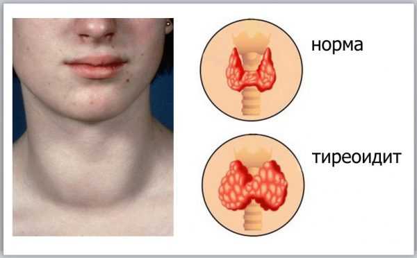 Щитовидная железа в норме и при аутоиммунном тиреоидите