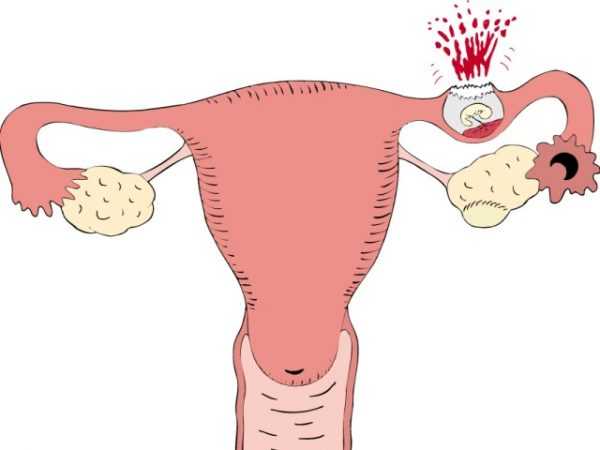 Прикрепление эмбриона при внематочной трубной беременности и разрыв трубы