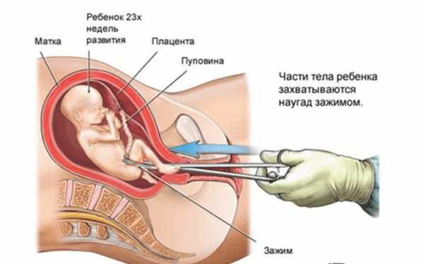 Процедура проведения хирургического аборта на сроке беременности в 23 недели