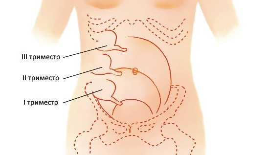 Схема расположения аппендикса на протяжении беременности