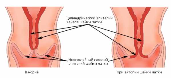 Расположение цилиндрических клеток эпителия на поверхности цервикса в норме и при эктопии