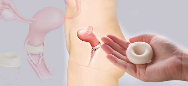 Расположение контрацептивной губки во влагалище