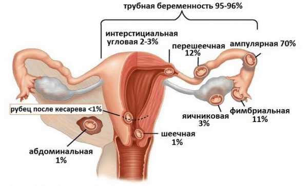 Разновидности внематочной беременности по месту локализации эмбриона