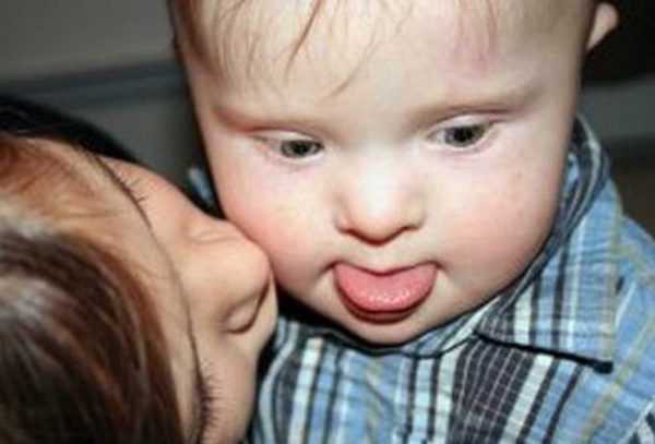 мальчик с синдромом Дауна, которого целует мама