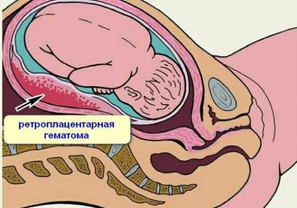 Ретроплацентарная гематома