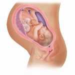 Схематическое изображение ребёнка в утробе с прикреплением плаценты по передней стенке