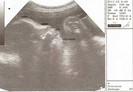 Снимок УЗИ на 42-й неделе беременности