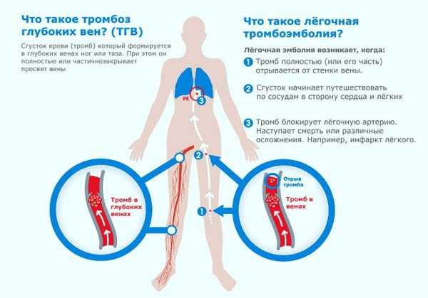 схематическое изображение возникновения тромбоза глубоких вен и легочной тромбоэмболии