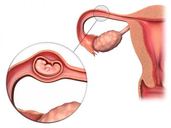 Пример внематочной трубной беременности