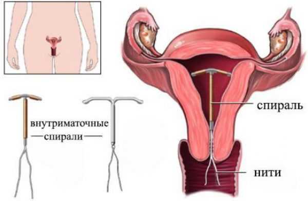 Внутриматочная спираль, установленная в полость матки